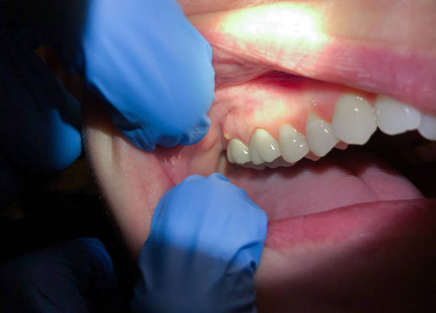 Best Emergency Treatment for Toothache in Cloverdale, IN