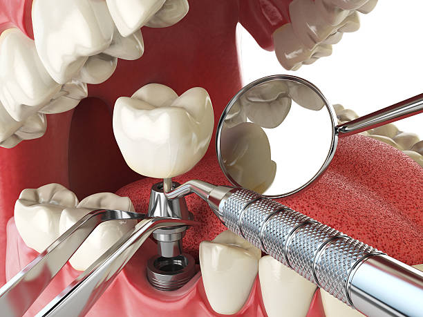 Best Emergency Treatment for Toothache in Cloverdale, IN